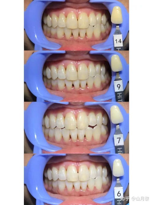 牙科醫生眼中真正有效的美白及口腔衛生用品
